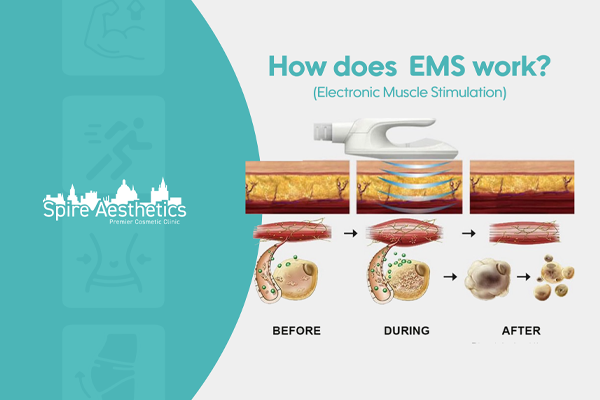 EMS treatment for post pregnancy weight loss treatment Higham Ferrers