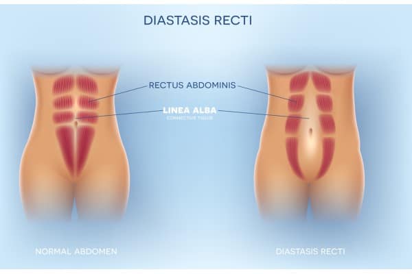 What Non-Surgical Options Are Available for Diastasis Recti Higham Ferrers?