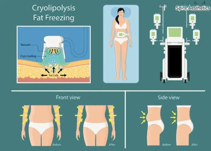 Fat freezing treatment Higham Ferrers benefits for competitions to remove stubborn fat deposits.