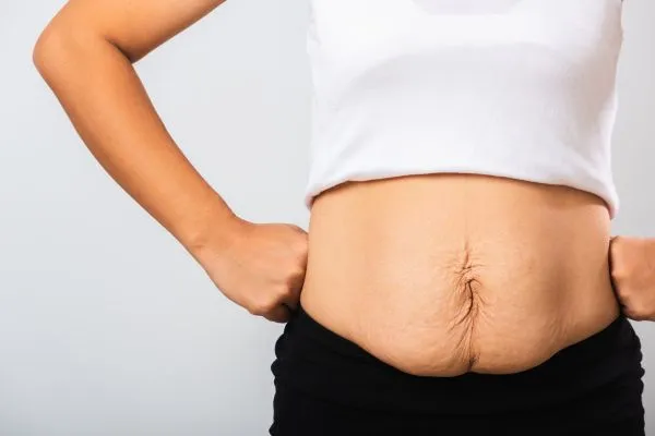 Image of a woman's stomach after weight loss with sagging skin following a gastric band Higham Ferrers