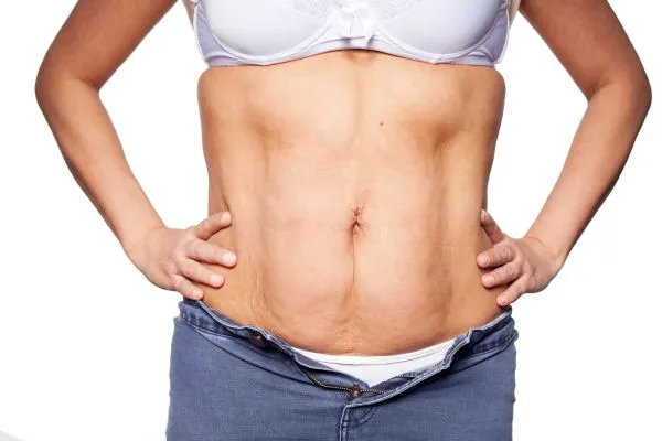 sagging skin on woman's stomach after weight loss injections Higham Ferrers