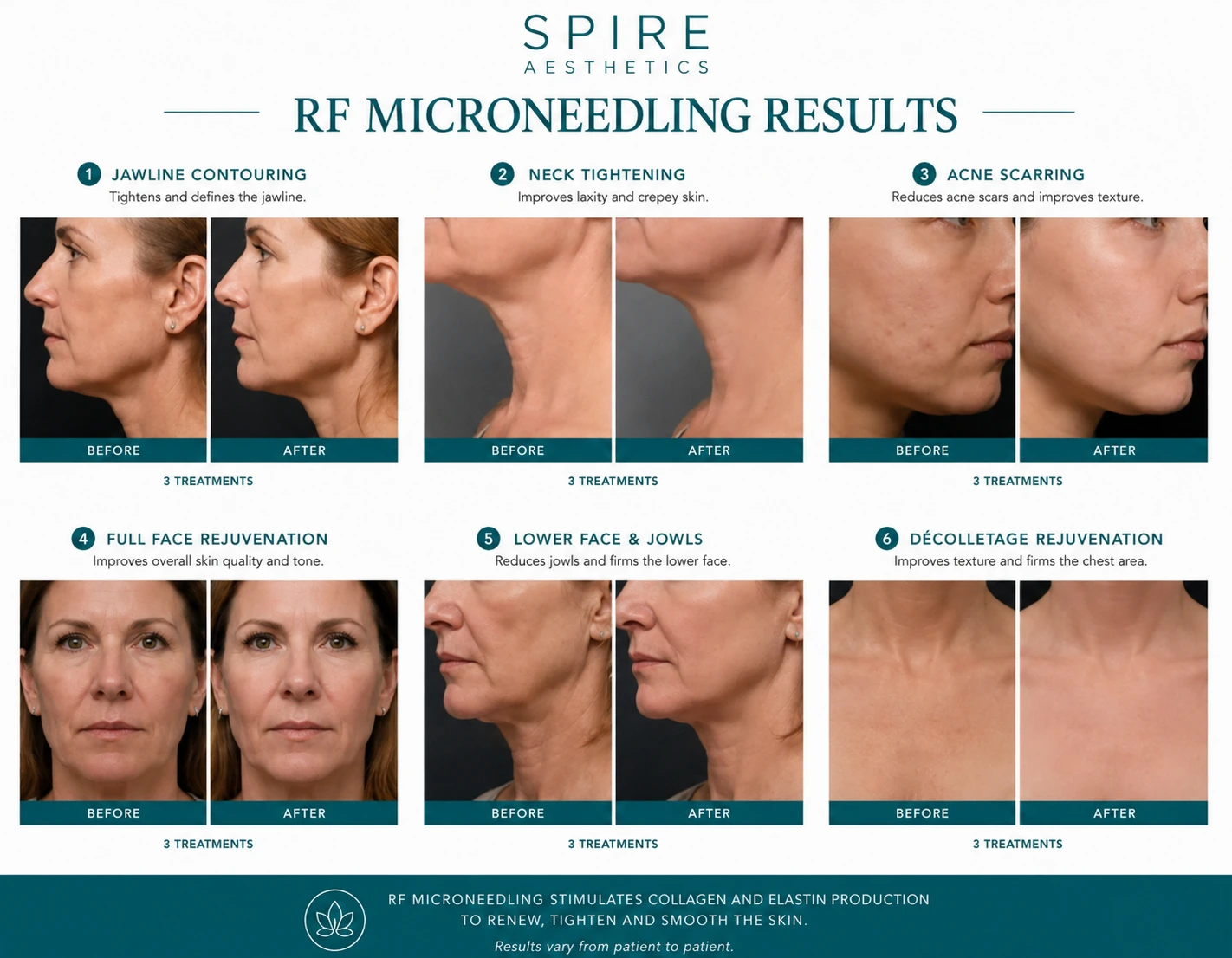 RF Microneedling Skin tightening Higham Ferrers results