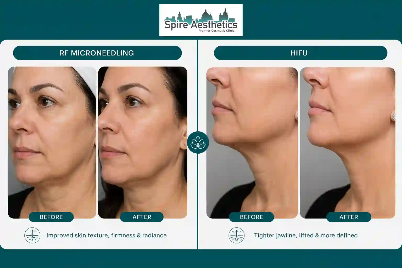 Can RF Microneedling and HIFU Be Combined Higham Ferrers?