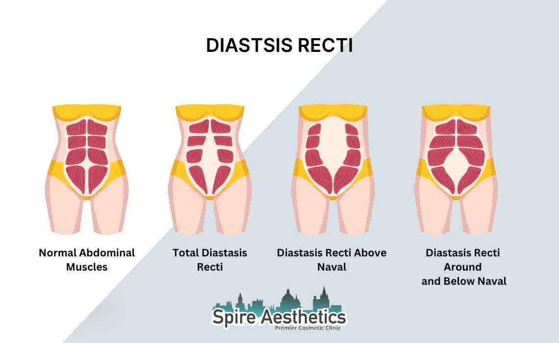 Is Non-Surgical Diastasis Recti Treatment Right for You? Common Concerns Answered Higham Ferrers